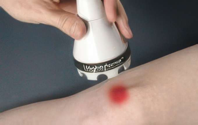 Laser therapy targeting knee pain with highlighted treatment area for inflammation and recovery